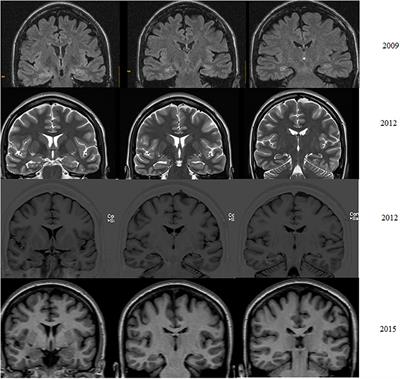 Hippocampus and Insula Are Targets in Epileptic Patients With Glutamic Acid Decarboxylase Antibodies